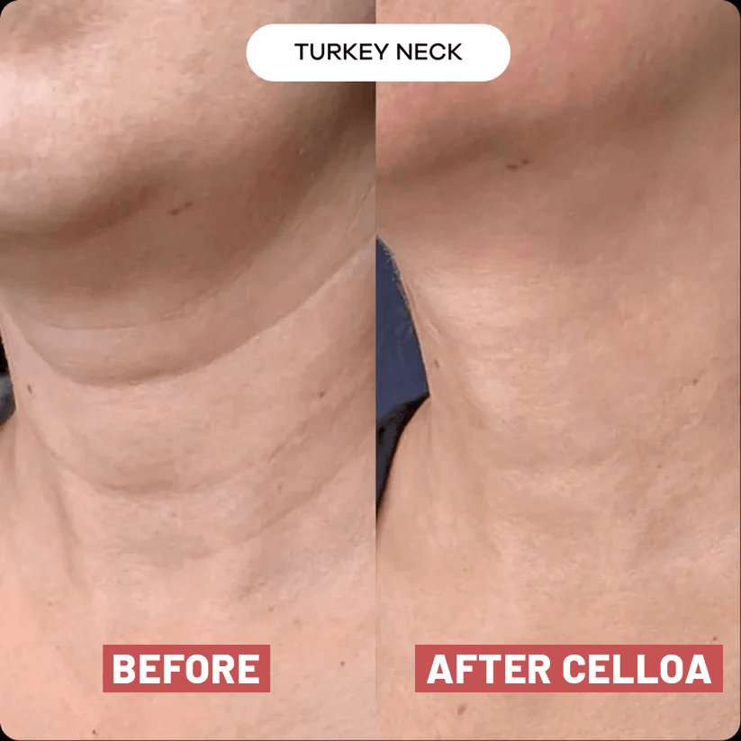 The Cellôa™ Lift (New Version - 2026)
