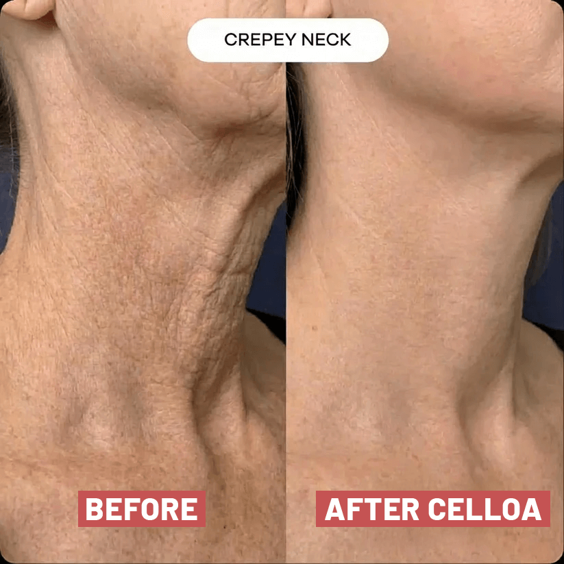 The Cellôa™ Lift (New Version - 2026)