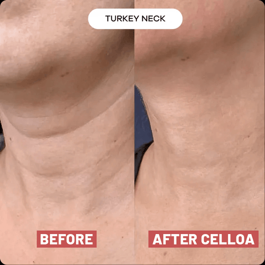 The Cellôa™ Lift (New Version - 2026)