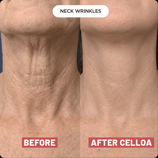 The Cellôa™ Lift (New Version - 2026)